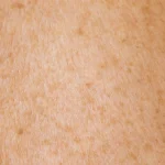 tache brune visage — Tache brune visage : les critères qui décident - Beaute.guide